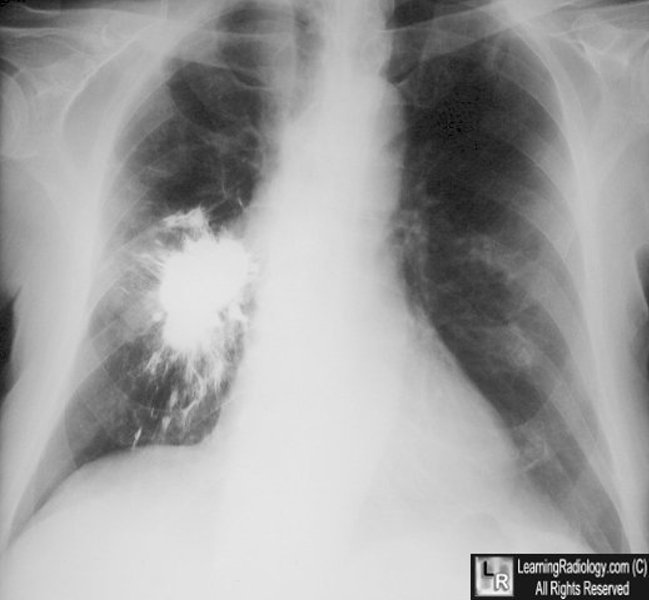 Aspirated Barium